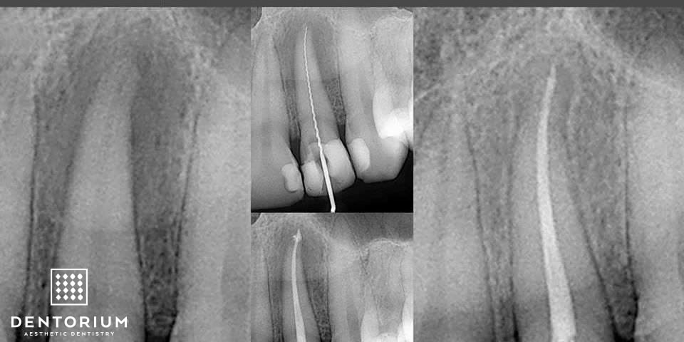 processo periapicale attorno all'apice della radice del dente