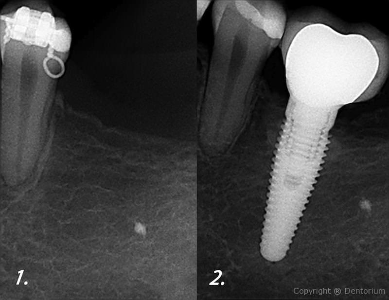 impianti dentali - denti di sostituzione