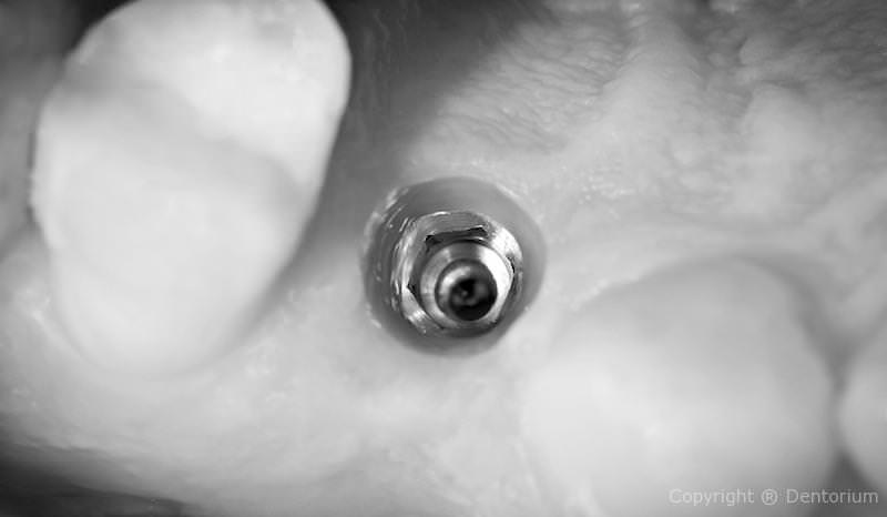 impianti dentali - denti di sostituzione