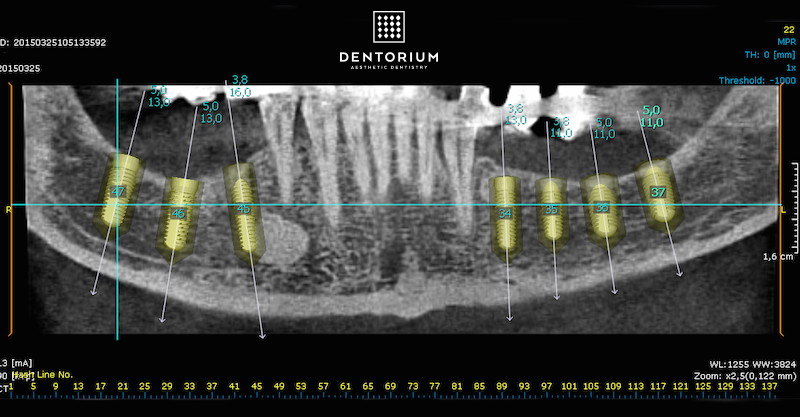 impianti dentali - denti di sostituzione