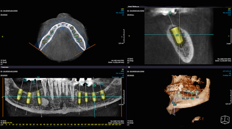impianti dentali - denti di sostituzione