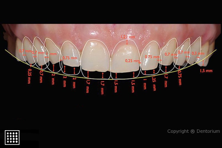 digital smile design
