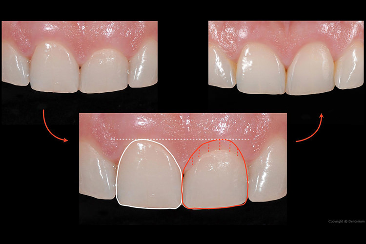 Trattamento Parodontale