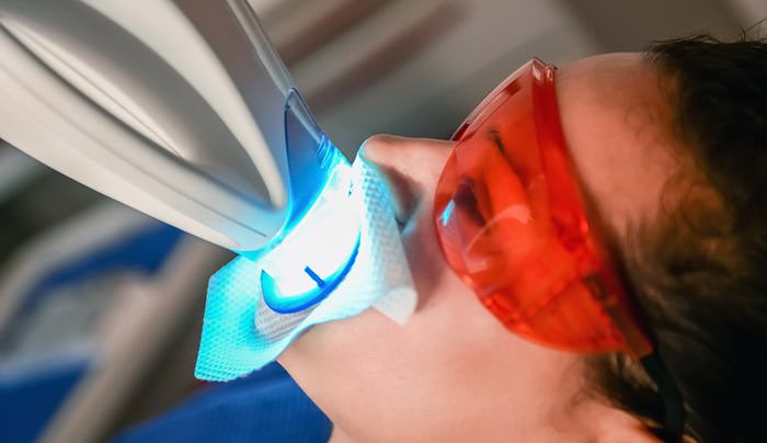 lo sbiancamento dentale