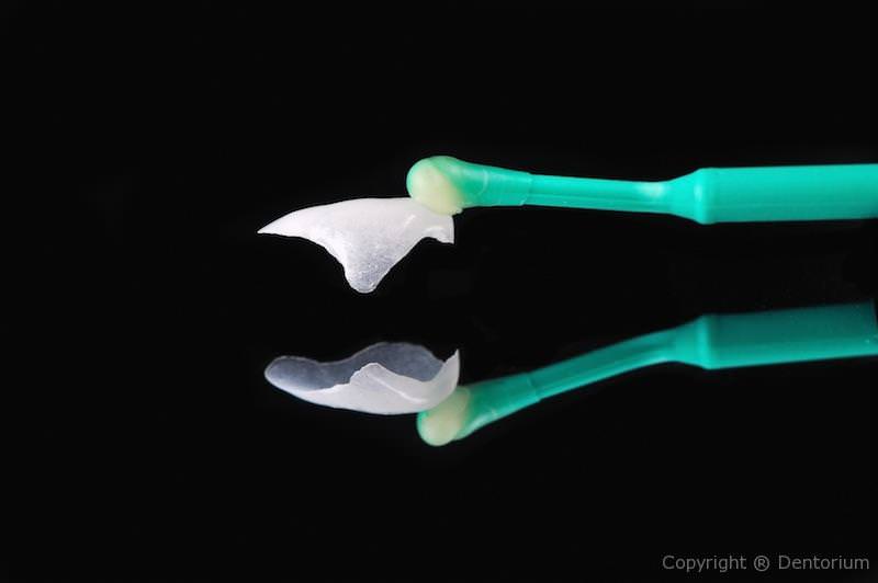 faccette ceramica - prepless faccett