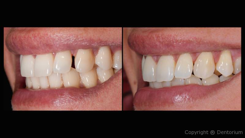 faccette ceramica - prepless faccett